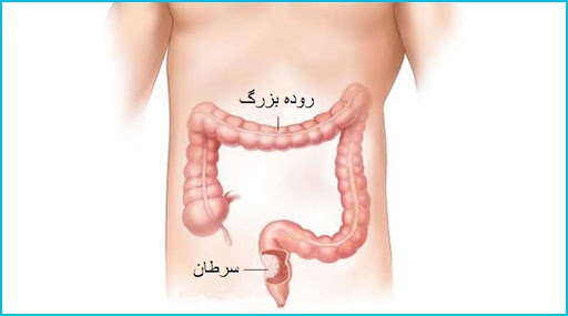 سرطان روده| درمان سرطان| ابتلا به سرطان